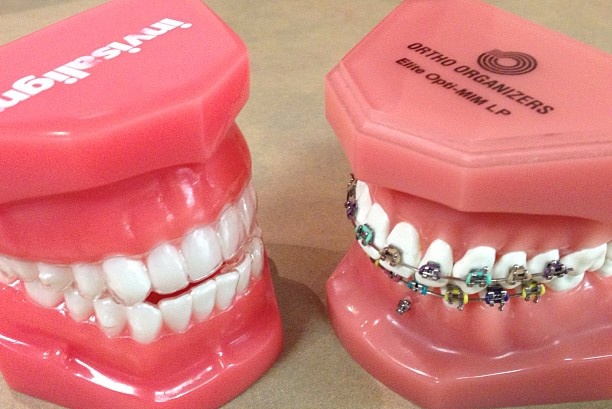 invisalign versus traditional braces